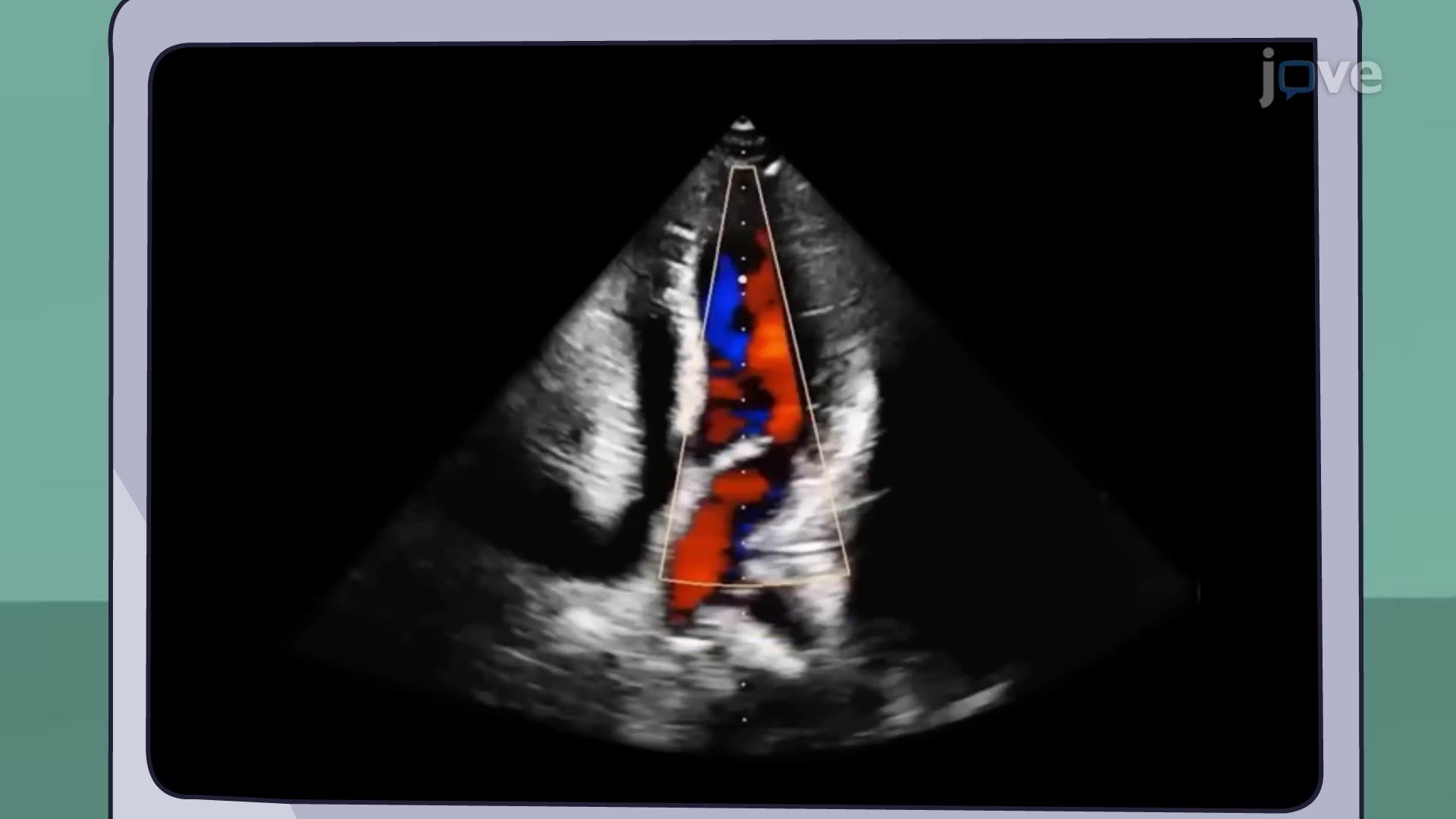 Cardiomyopathy VI: Nursing Management
