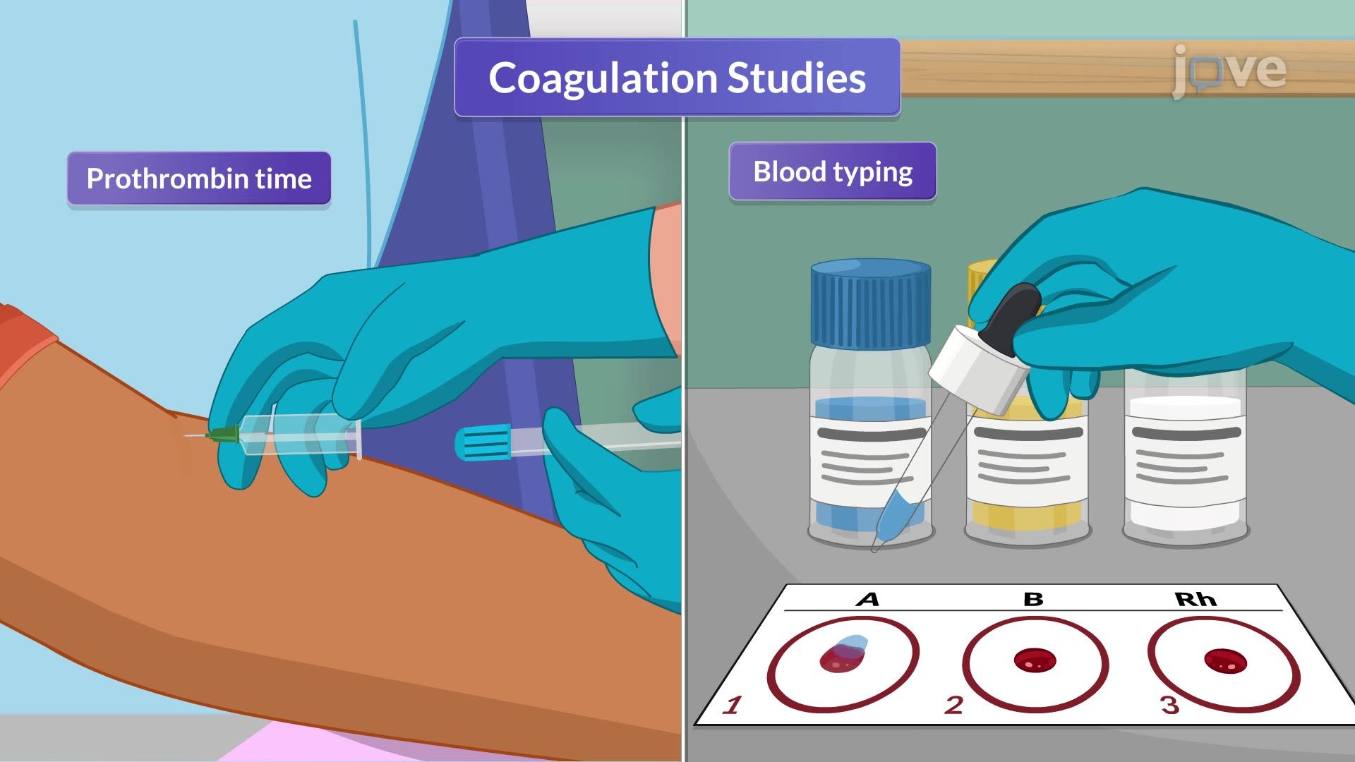 Cardiomyopathy VII: Pre and Post Operative Nursing Management