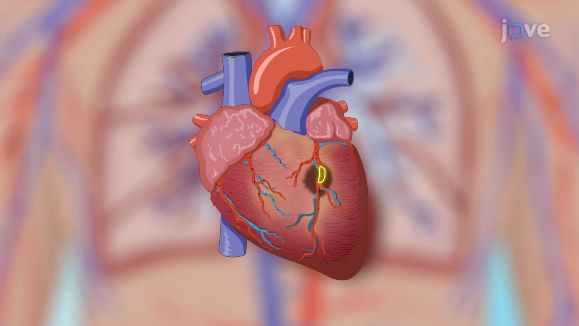 Atherosclerosis II: Clinical Manifestations and Diagnostic Tests