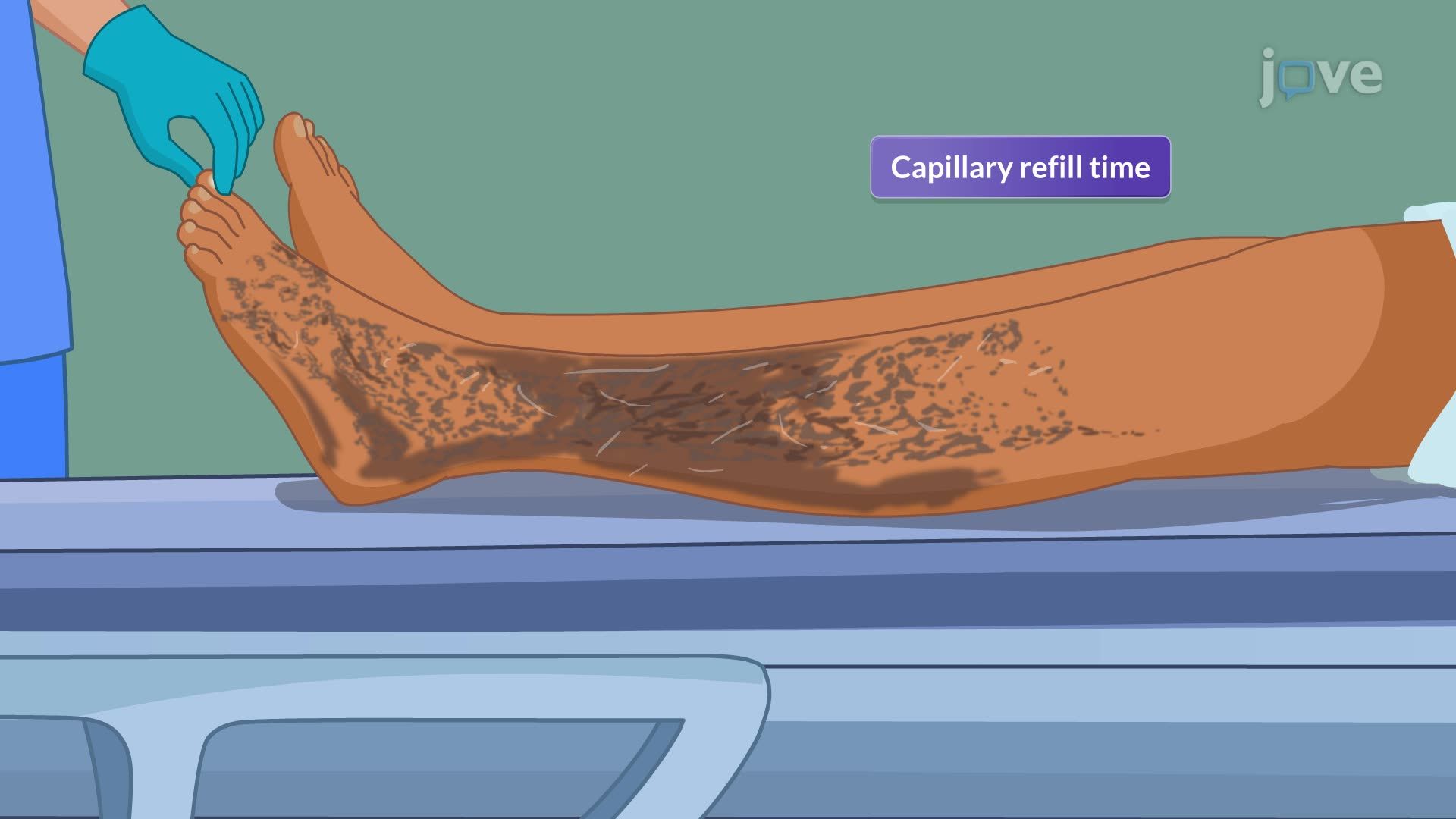 Peripheral Artery Disease IV: Nursing Management