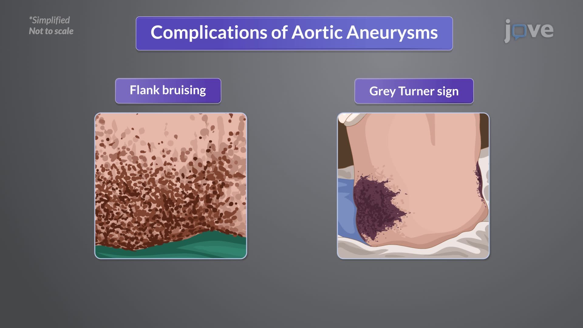 Aneurysm II: Clinical Manifestations and Diagnostic Studies