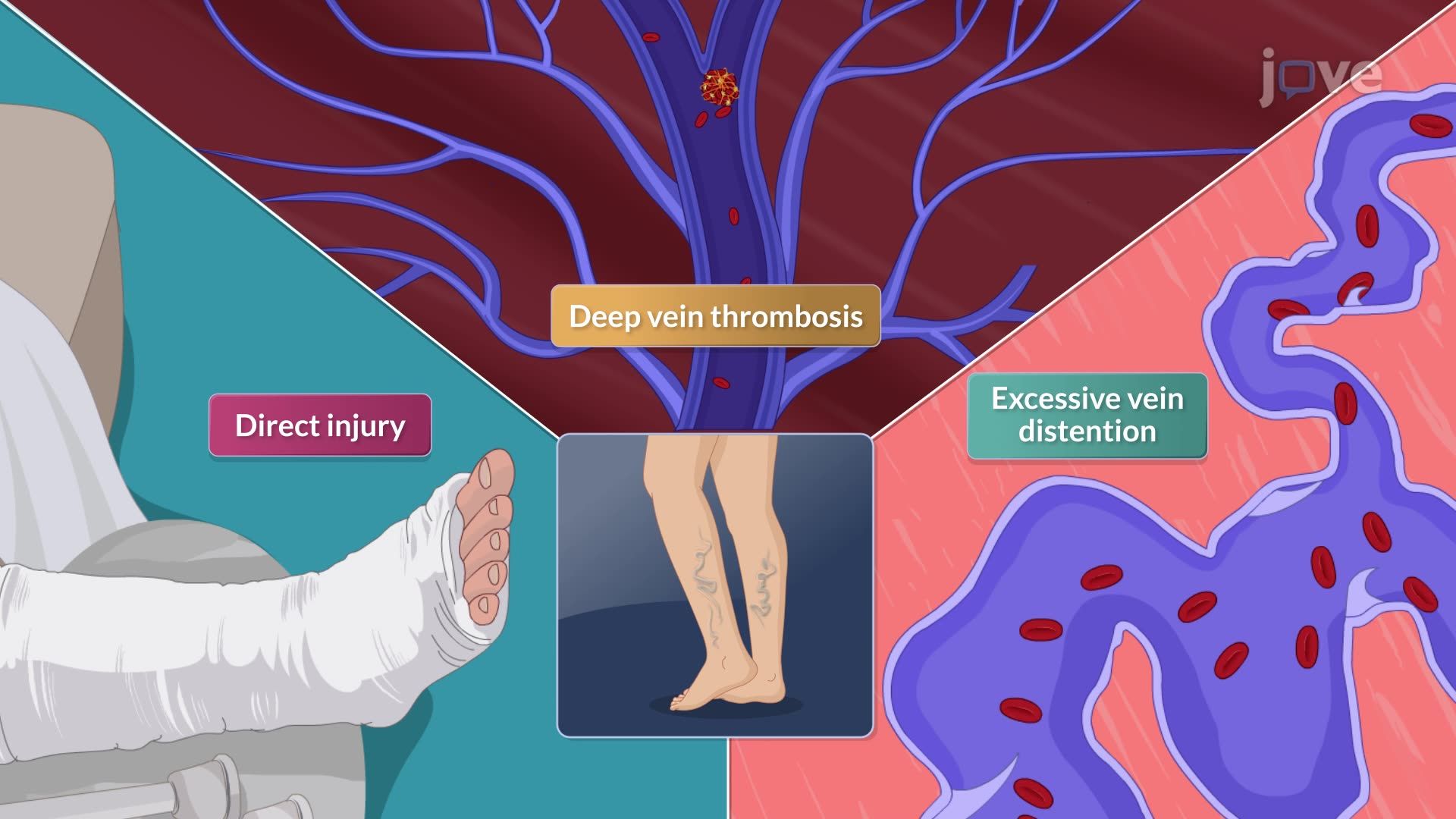 Varicose Veins I: Introduction