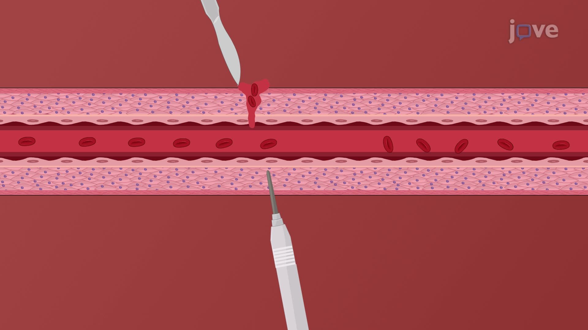 Venous Thrombosis I: Introduction