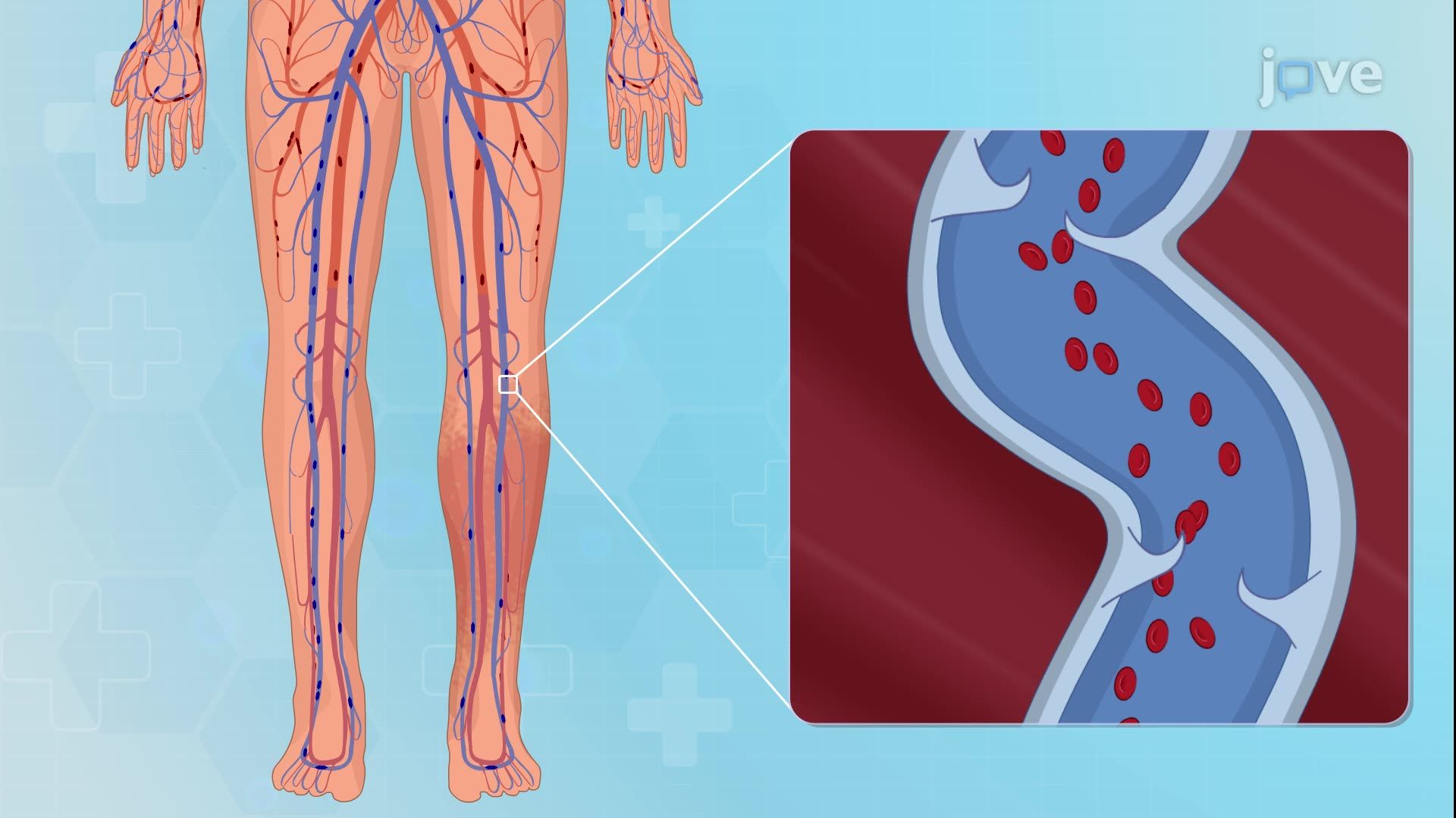 Venous Thrombosis IV: Nursing Management
