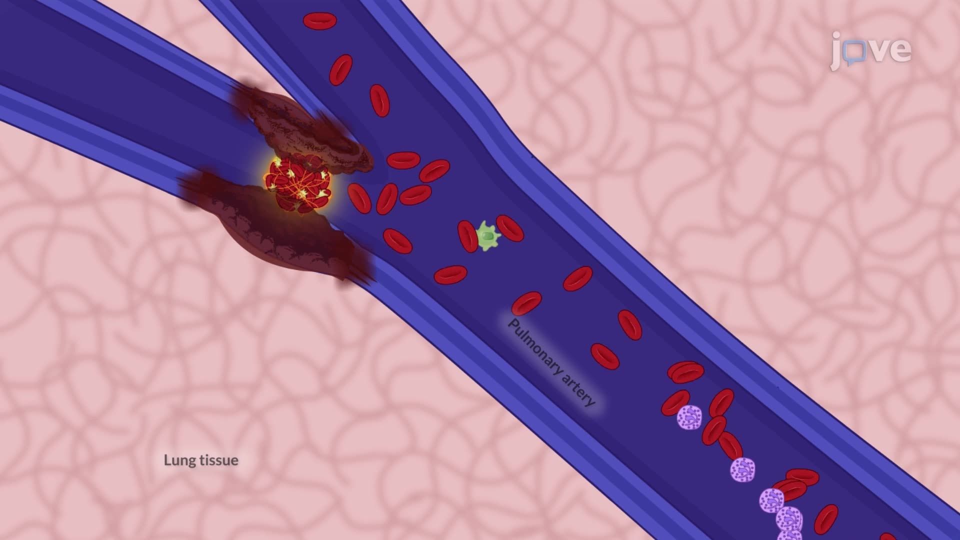 Pulmonary Embolism I: Introduction