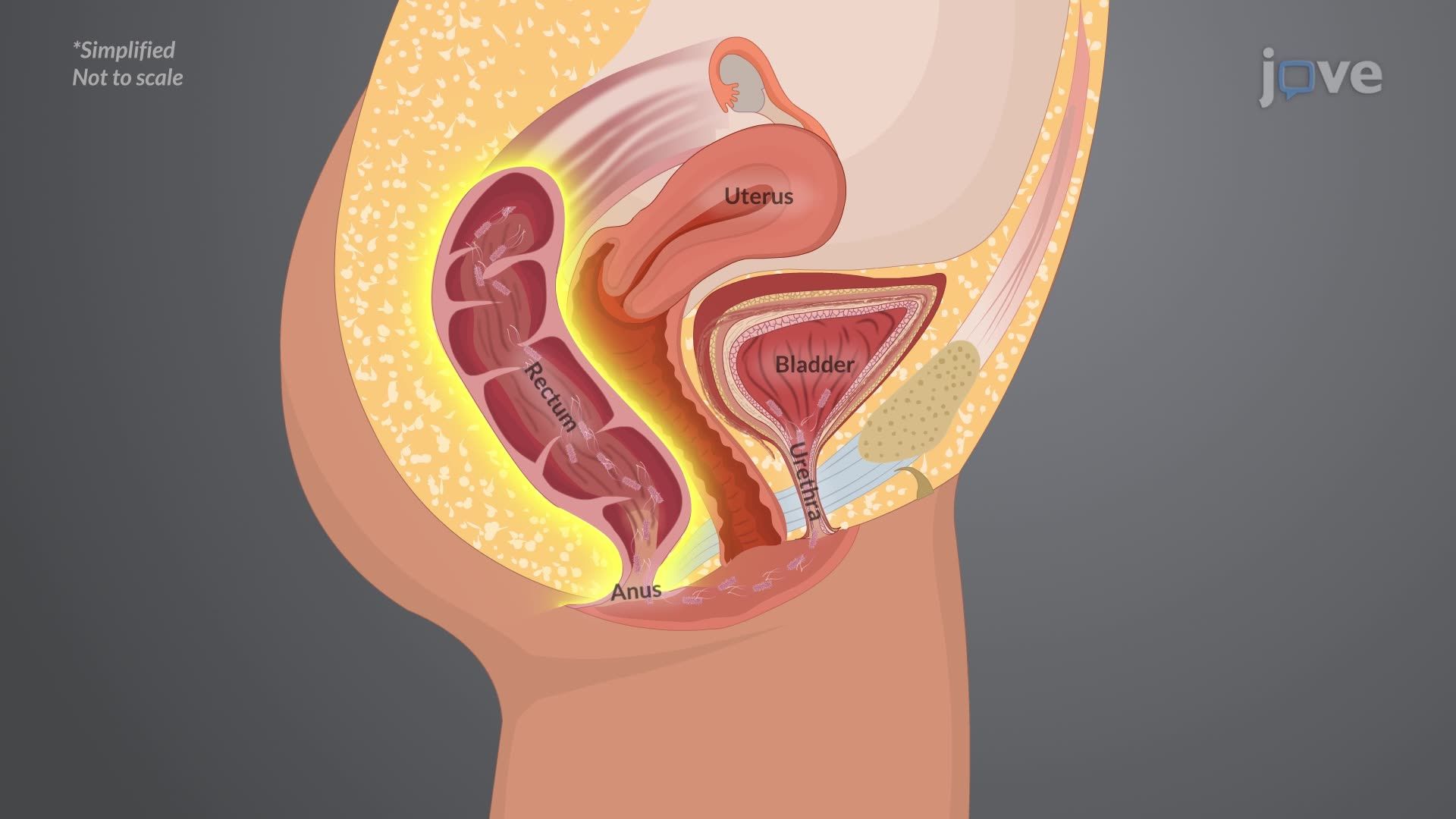 Urinary Tract Infection II: Pathophysiology
