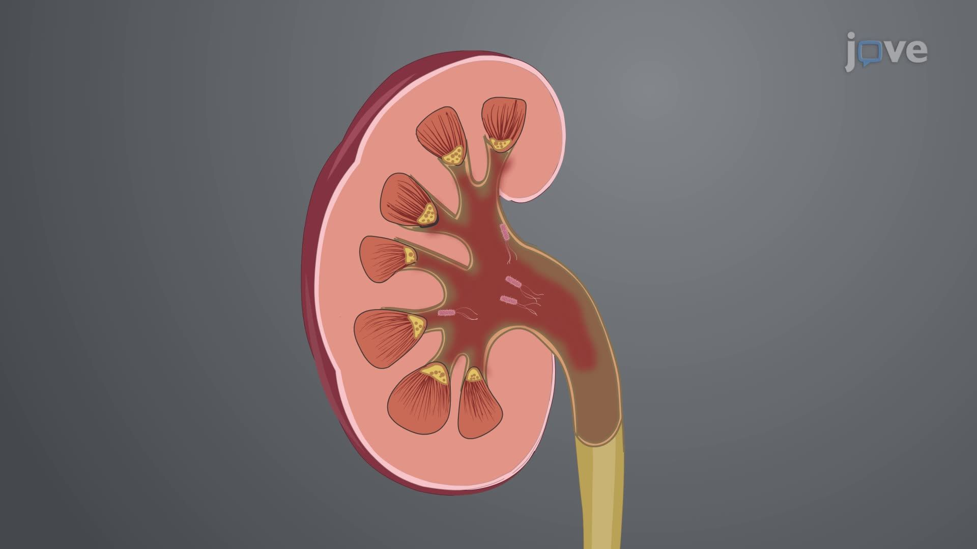 Acute Pyelonephritis I: Introduction