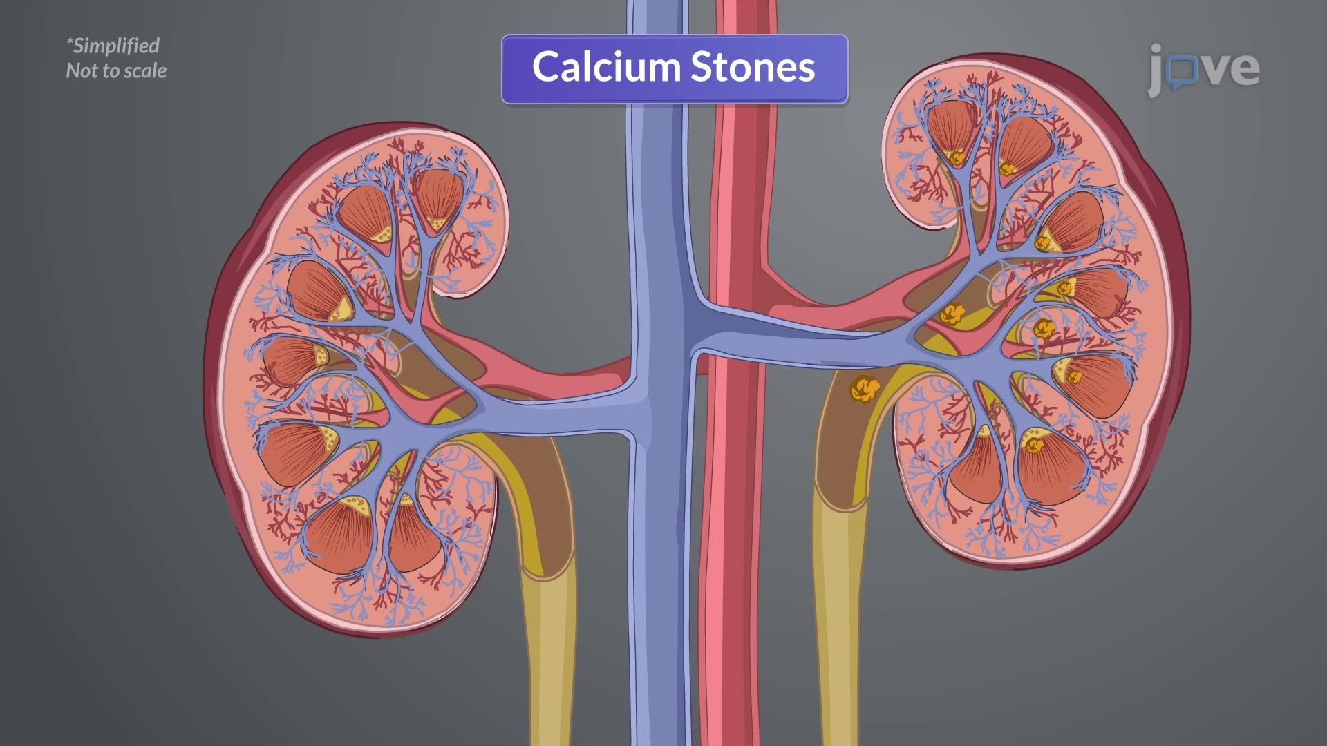 Urinary Tract Calculi I: Introduction