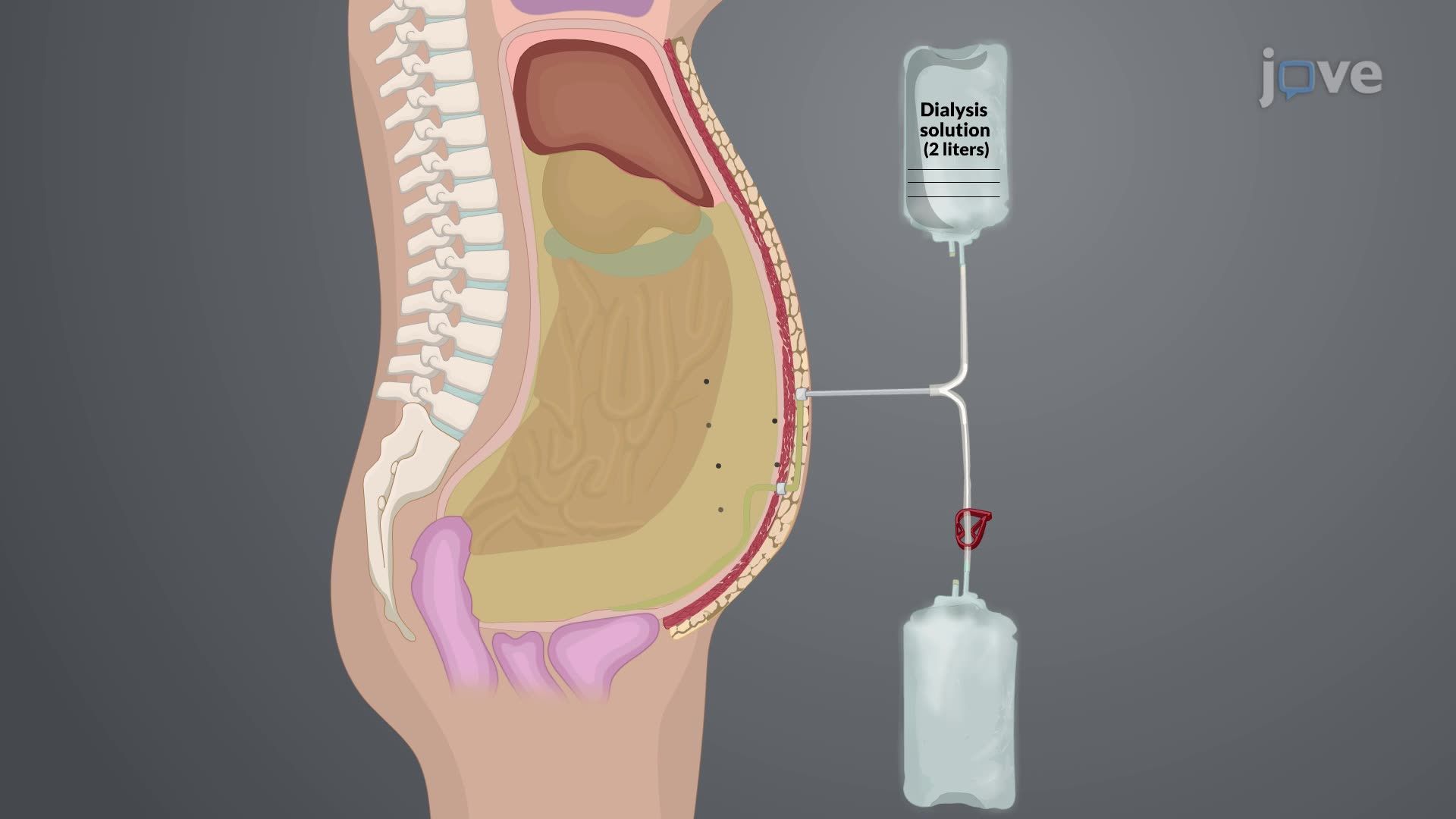 Peritoneal Dialysis I: Introduction and Procedure