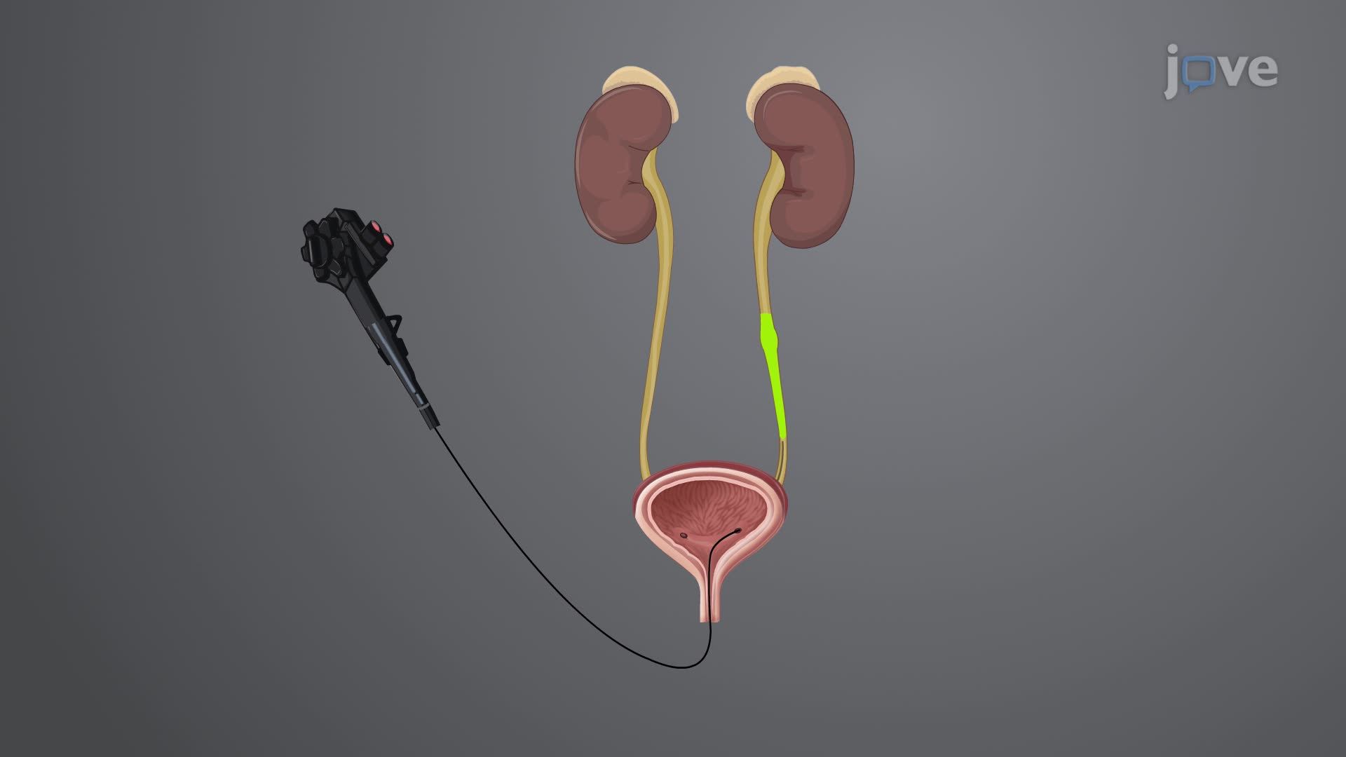 Imaging Studies V:  Intravenous Urography and Retrograde Pyelography