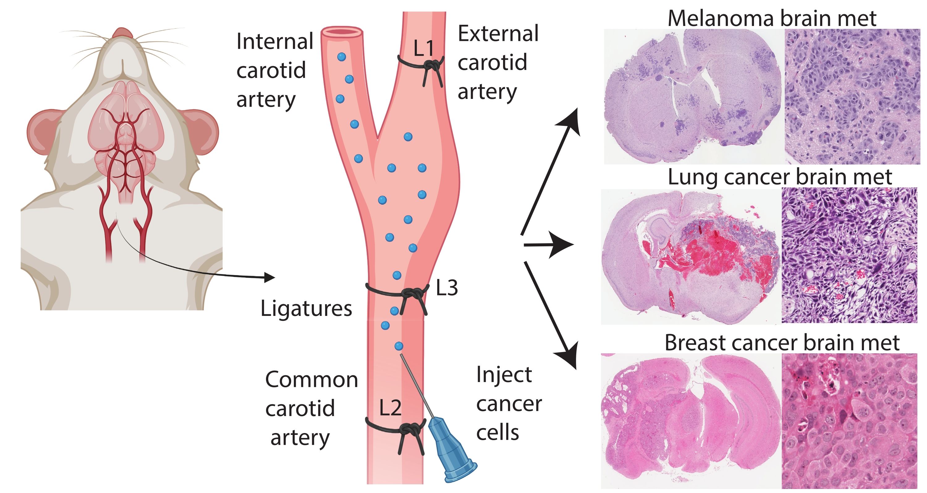 Mouse common carotid artery injection diagram, metastasis brain histology for melanoma, lung, breast cancer.