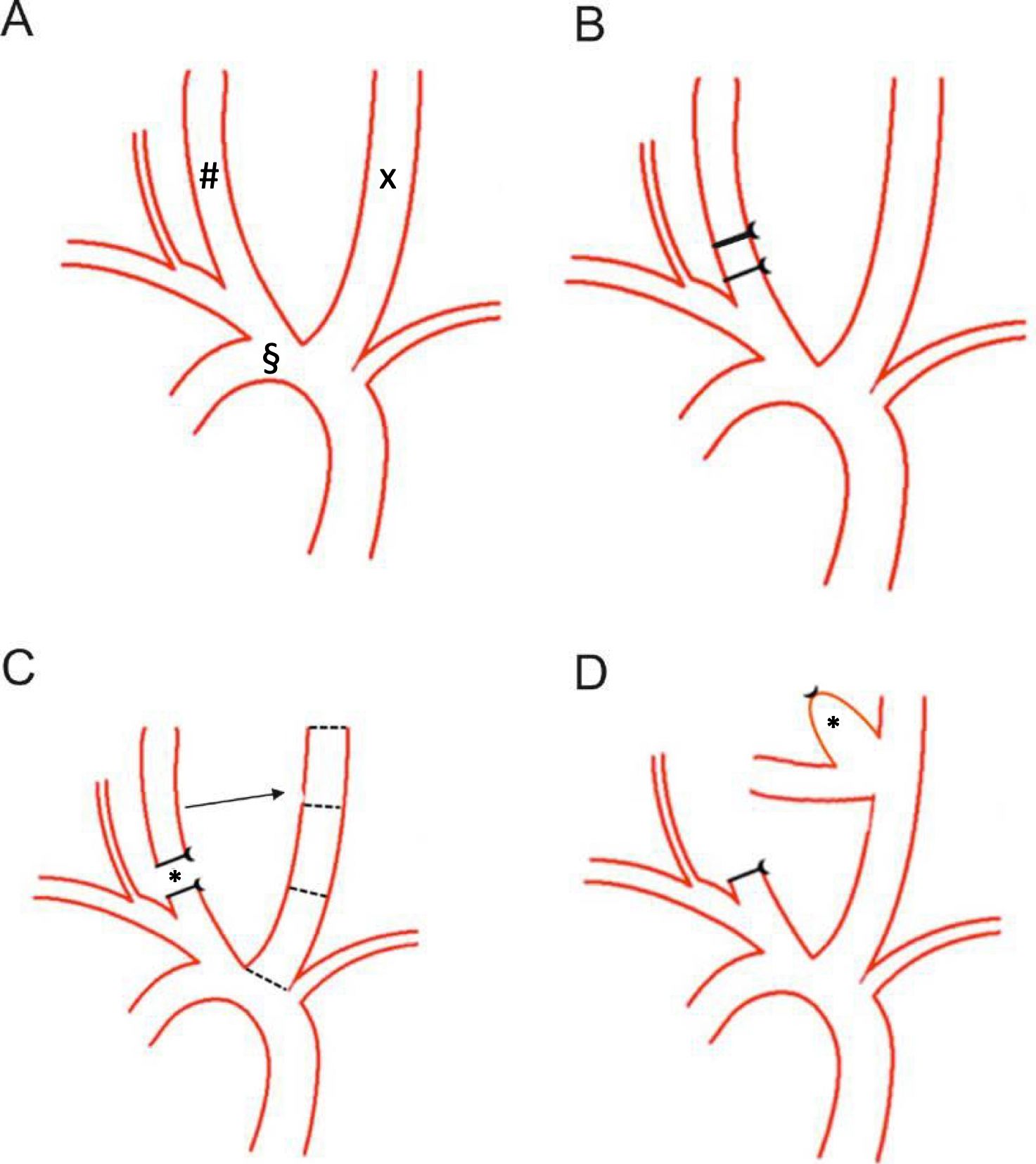Developing an Experimental Aneurysm Model in a Rabbit Using an Elastase ...