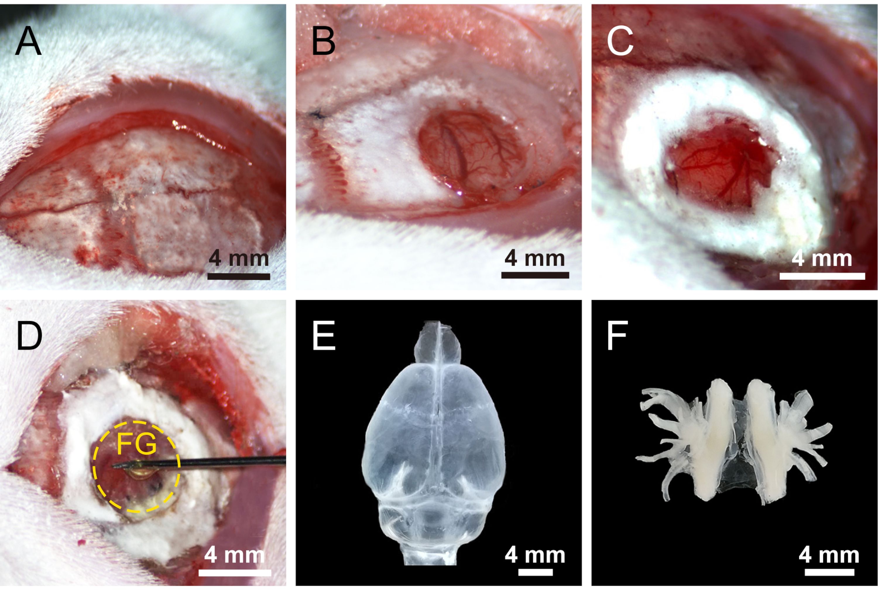 Surgical procedure images on cranial repair. Includes brain exposure, FG application, and 3D skull model.