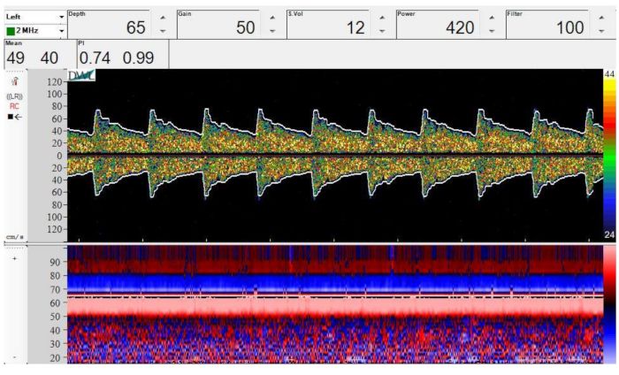 Functional Imaging of Cerebral Blood Flow Using Transcranial Doppler ...