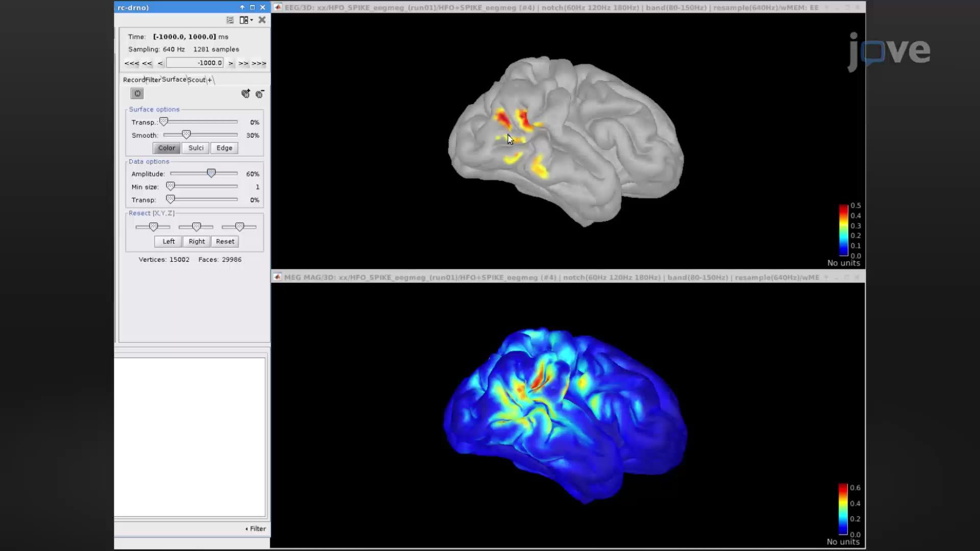  Simultaneous Electroencephalography and Magnetoencephalography to Identify Seizure-Prone Brain Regions 