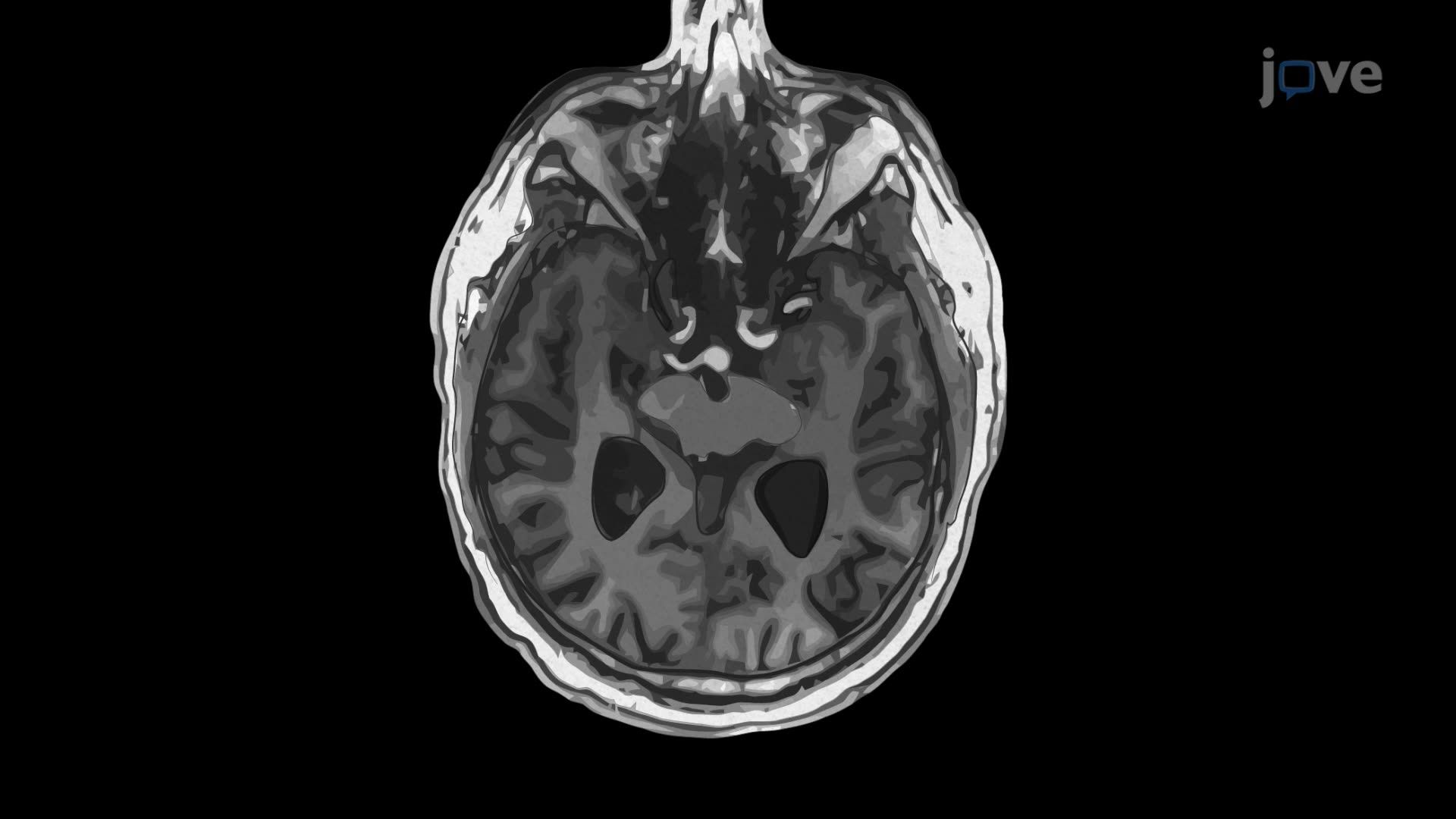 Magnetic Resonance Imaging of Cerebral Aneurysms Using MPRAGE