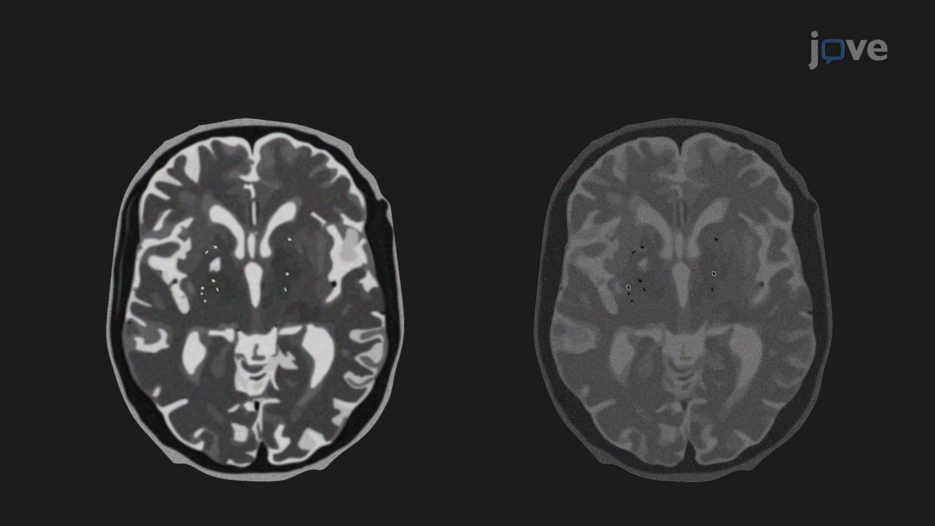 Magnetic Resonance Imaging of Perivascular Spaces in the Human Brain During a Small Vessel Stroke
