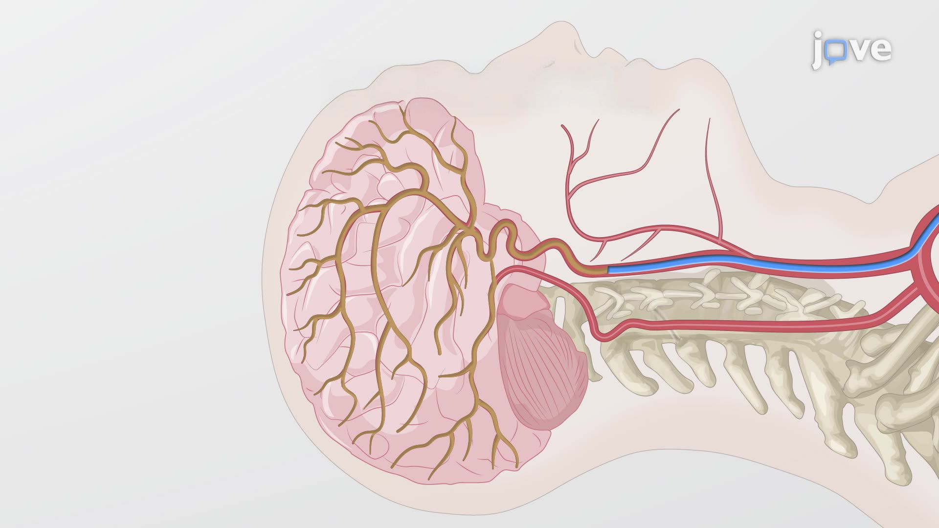 Detection of Internal Carotid Artery Narrowing Using Digital Subtraction Angiography