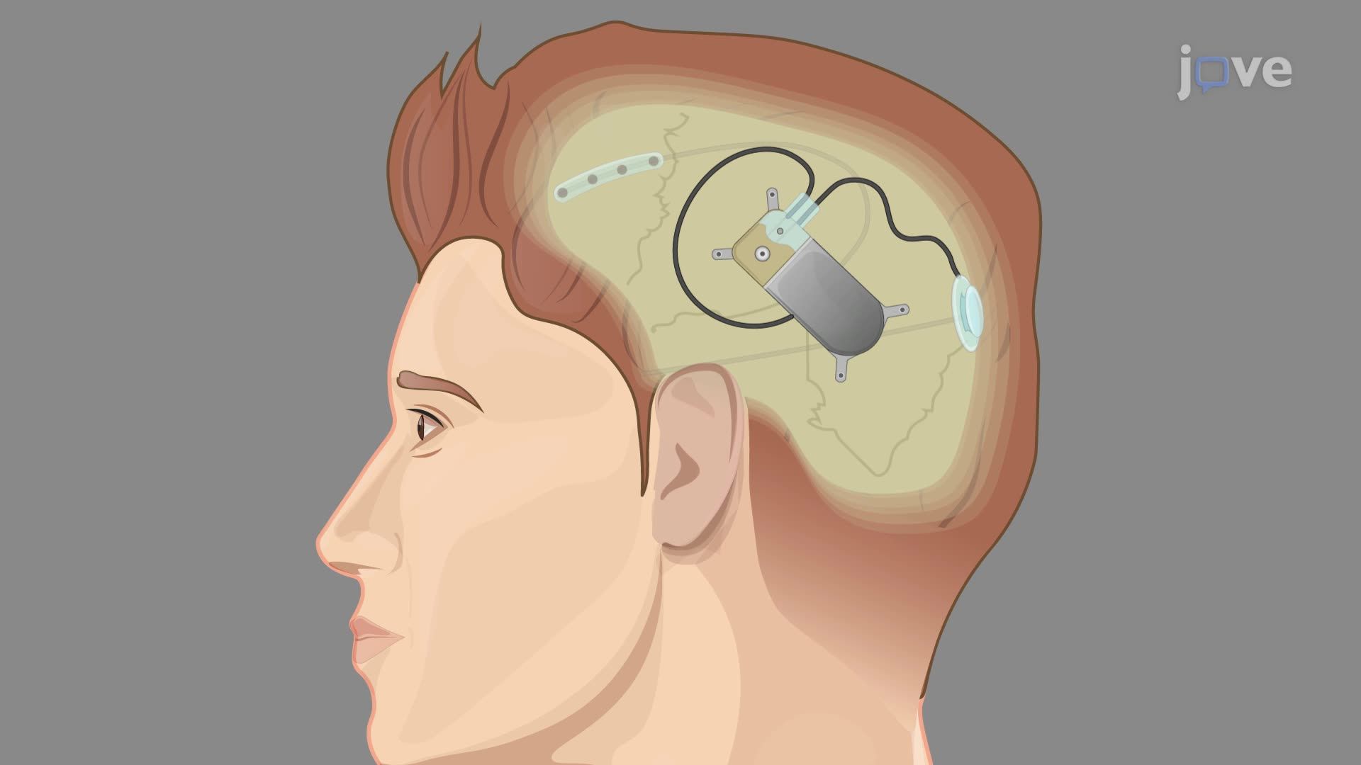 Neurostimulation System Setup and Symptom Collection for Personalized Treatment of Depression