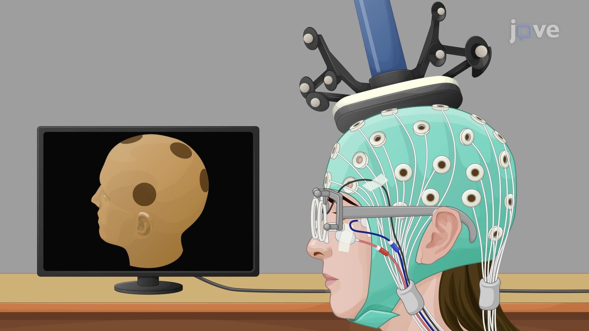 Assessing Brain Hyperexcitability with Transcranial Magnetic Stimulation and Electroencephalography