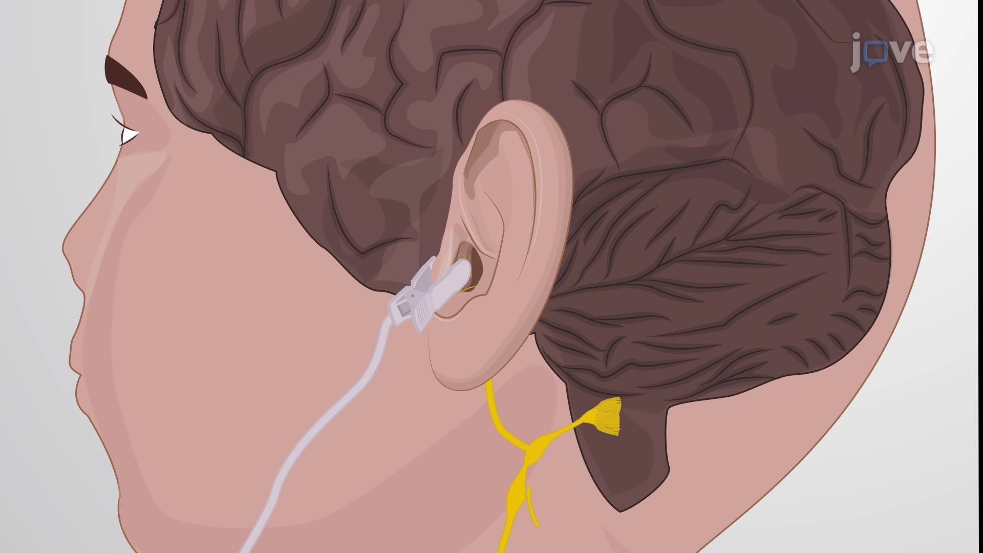 Transcutaneous Auricular Vagus Nerve Stimulation on the Human Ear