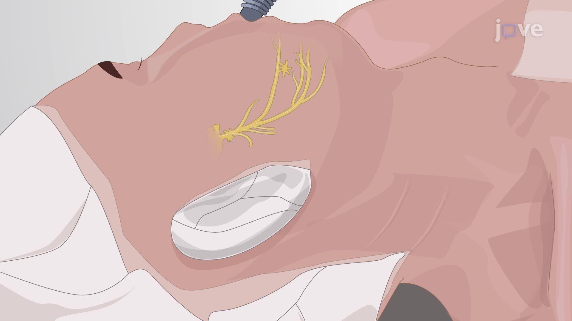 Subcutaneous Trigeminal Nerve Stimulation to Relieve Neuropathic Facial Pain