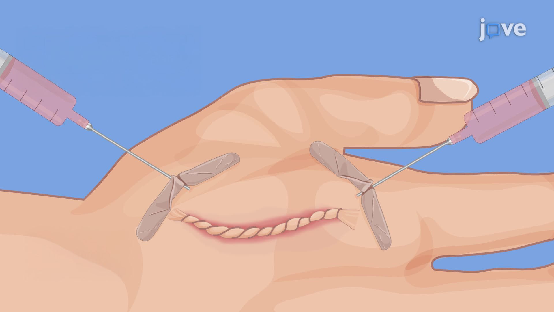 Stromal Vascular Fraction-Enriched Fat Grafting for the Management of Symptomatic Neuromas