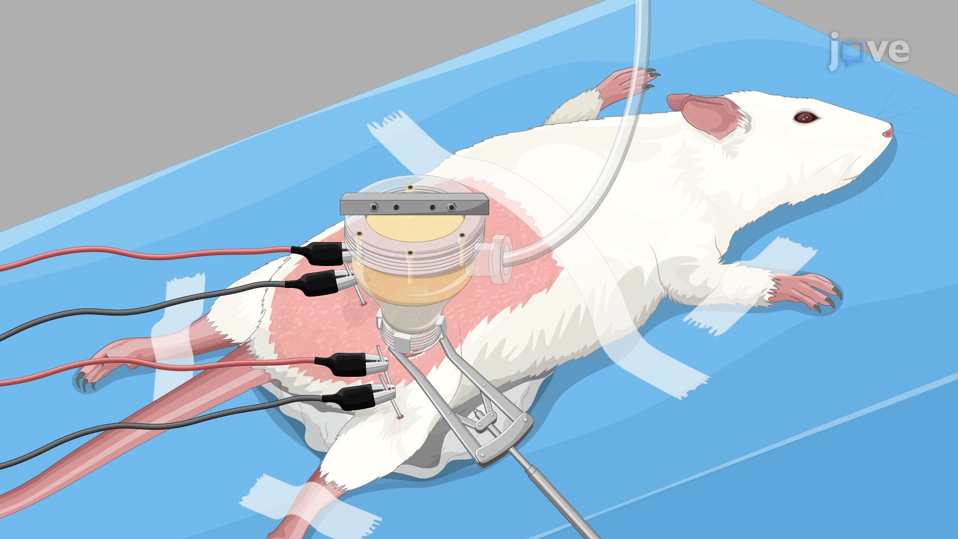 High-Intensity Focused Ultrasound for Blocking Nerve Action Potentials in a Diabetic Rat Model