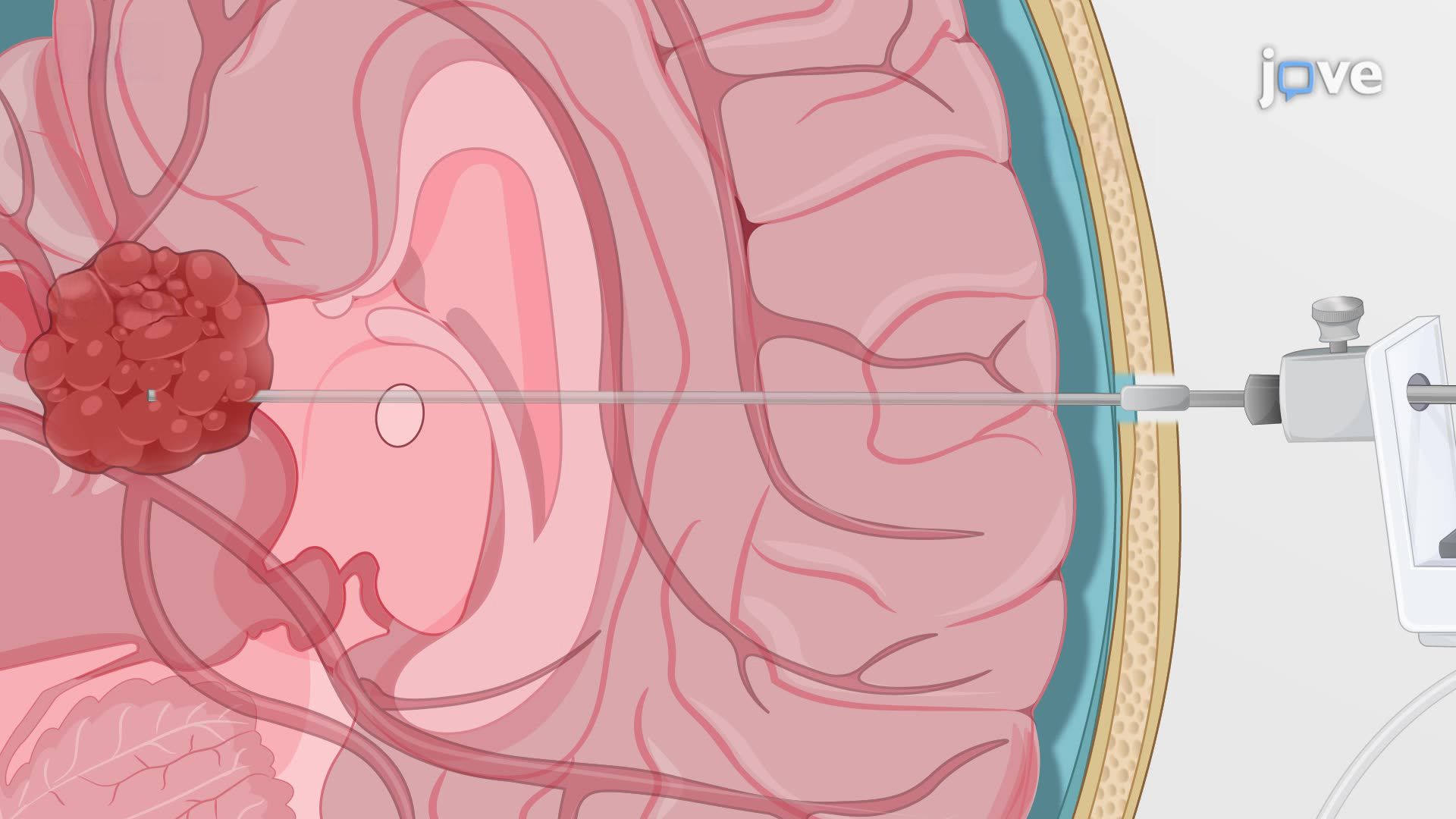 Laser Interstitial Thermal Therapy for Intracranial Tumor Ablation in a ...