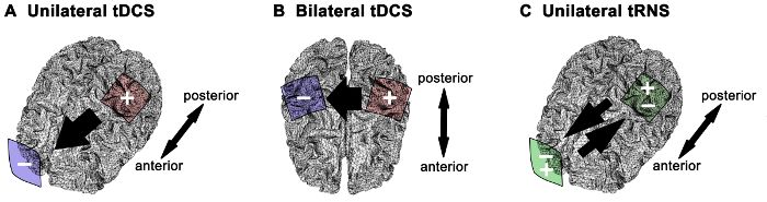 figure-results-1 Unilateral and bilateral tDCS, tRNS brain stimulation diagram with anterior-posterior orientation.