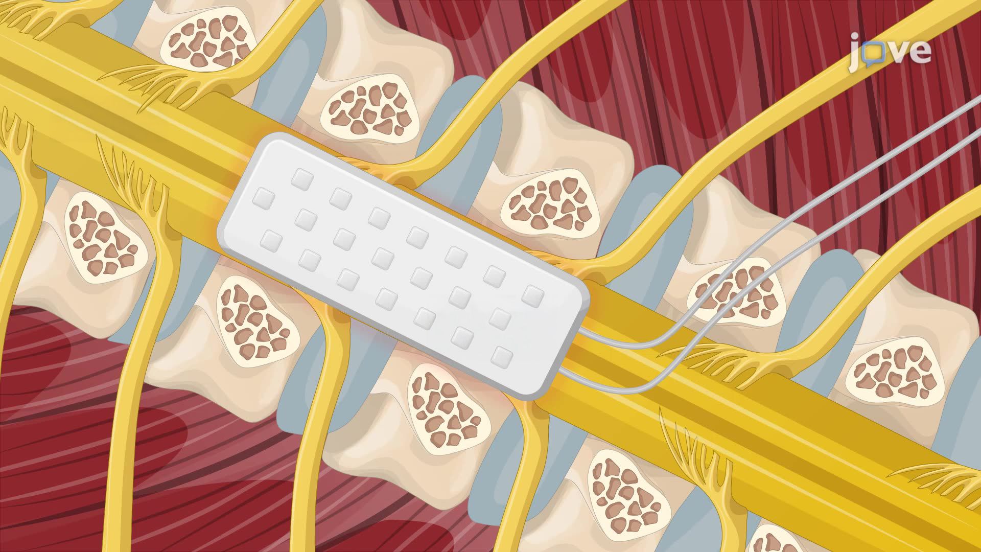 Modulation of Chronic Pain Using Multicolumn Paddle Lead Spinal Cord Stimulation