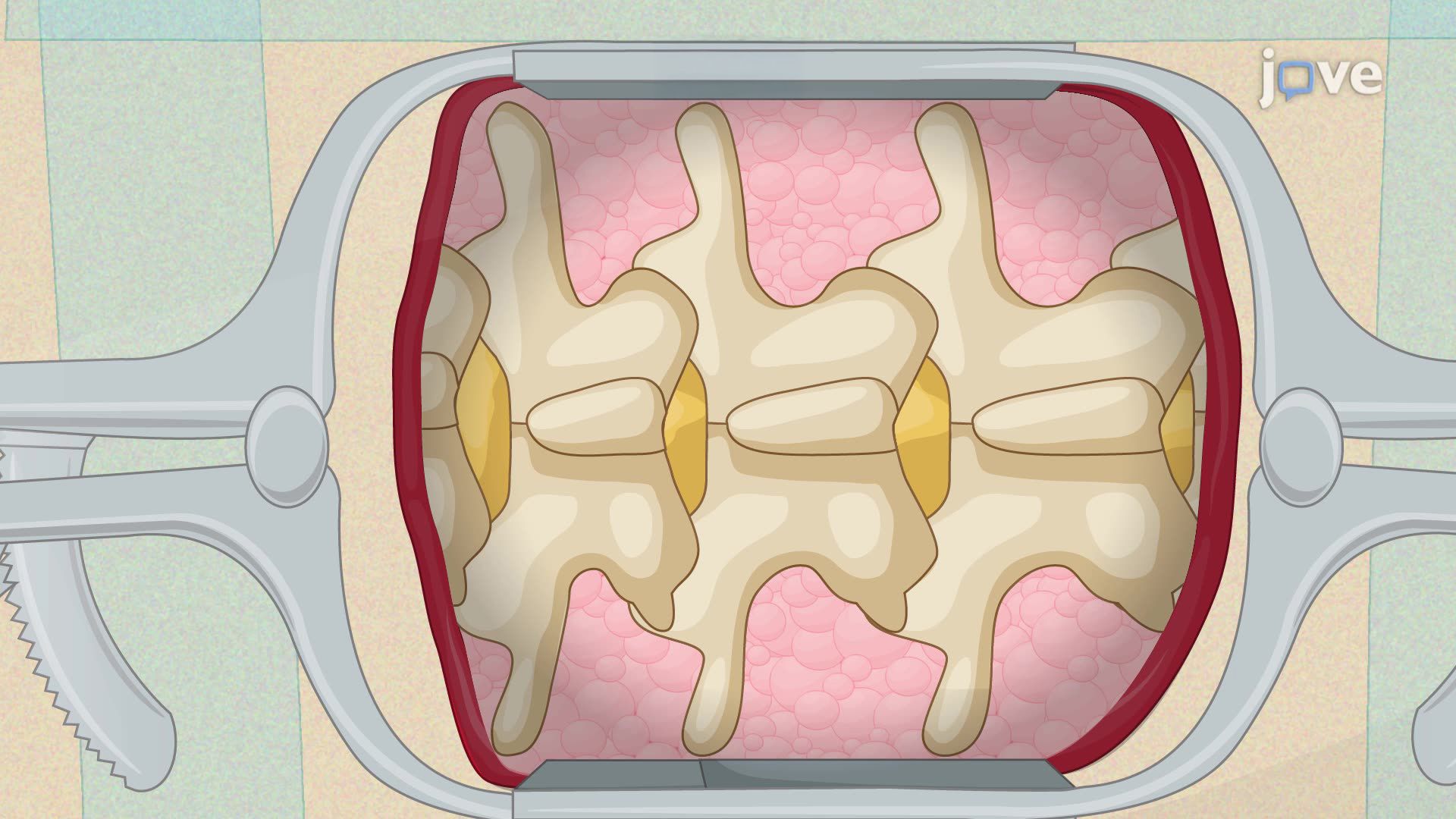 Laminotomy for Targeted Injection into the Lumbar Dorsal Root Ganglion in a Pig Model
