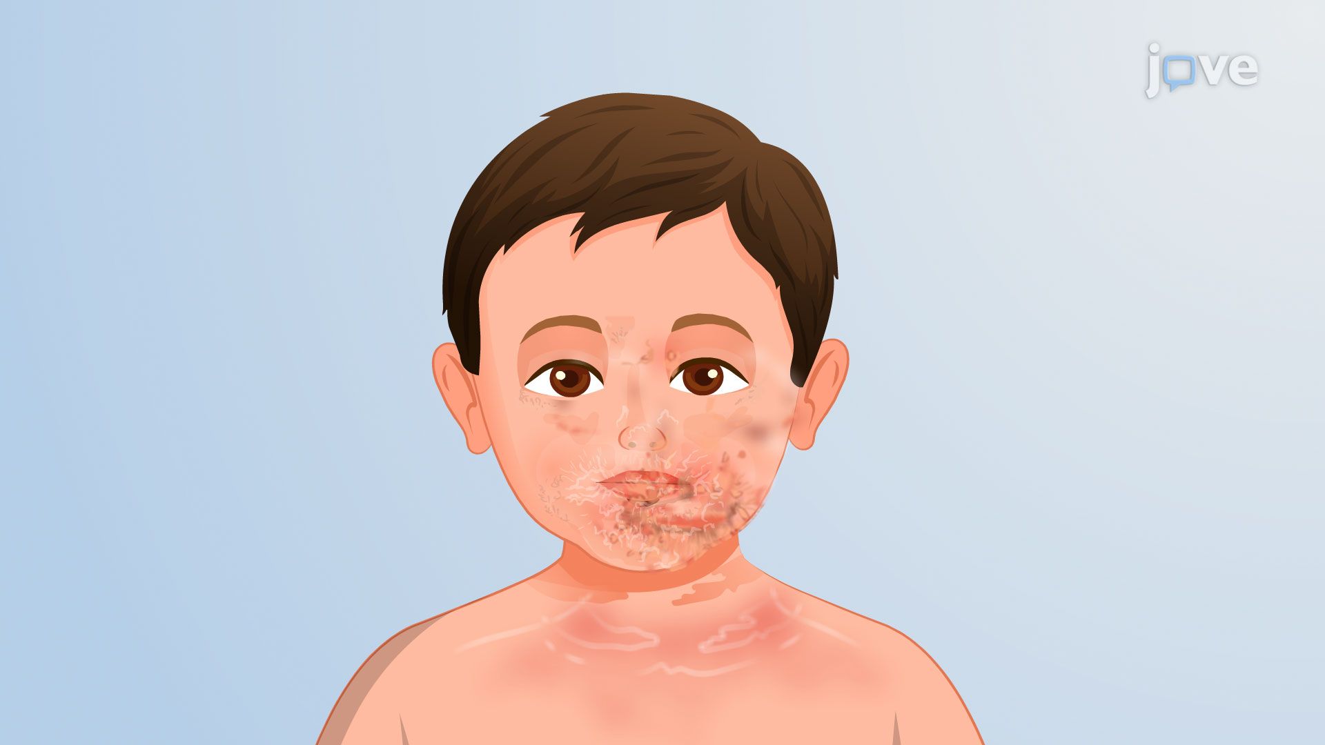 Thumbnail for Bacterial Diseases