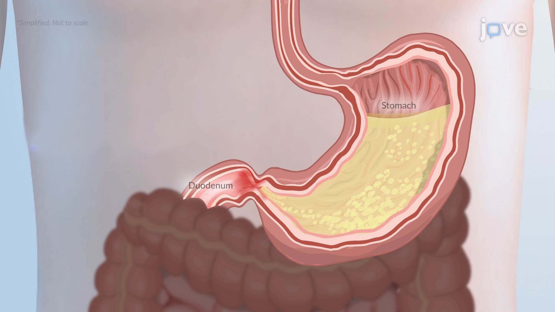 Pyloric Obstruction