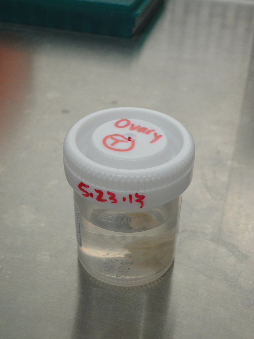 Specimen Cells Method for Obtaining Primary Ovarian Cancer Cells From Solid Specimens ...