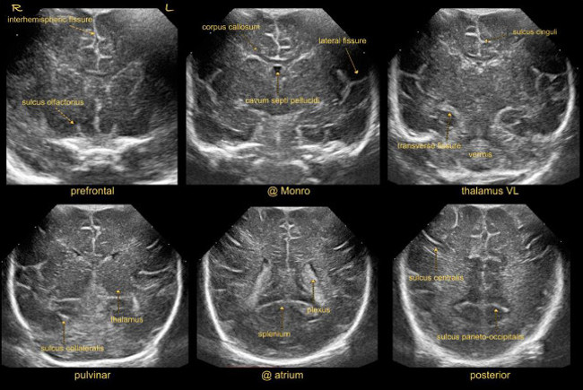 State Of The Art Cranial Ultrasound Imaging In Neonates