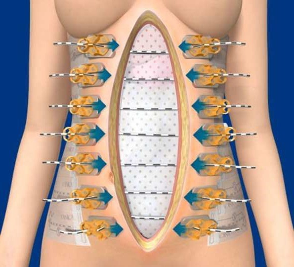 SciELO - Brasil - Temporary abdominal closure with zipper-mesh