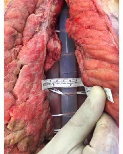 Figure S. Different devices for temporary abdominal closure for planned