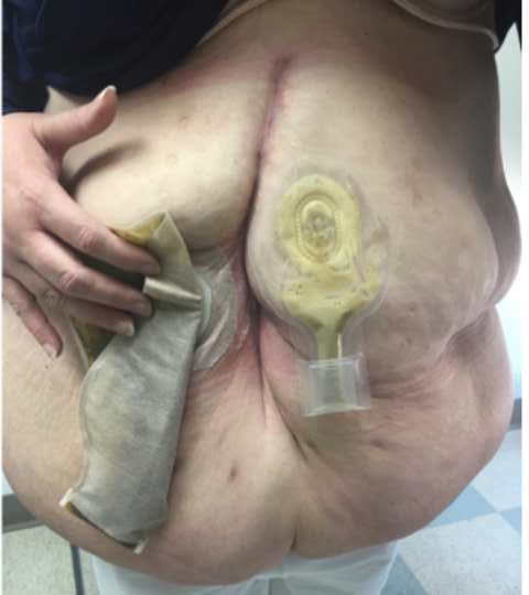 Figure S. Different devices for temporary abdominal closure for planned