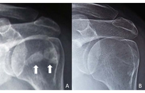 Treatment Protocol for Rotator Cuff Calcific Tendinitis Using a