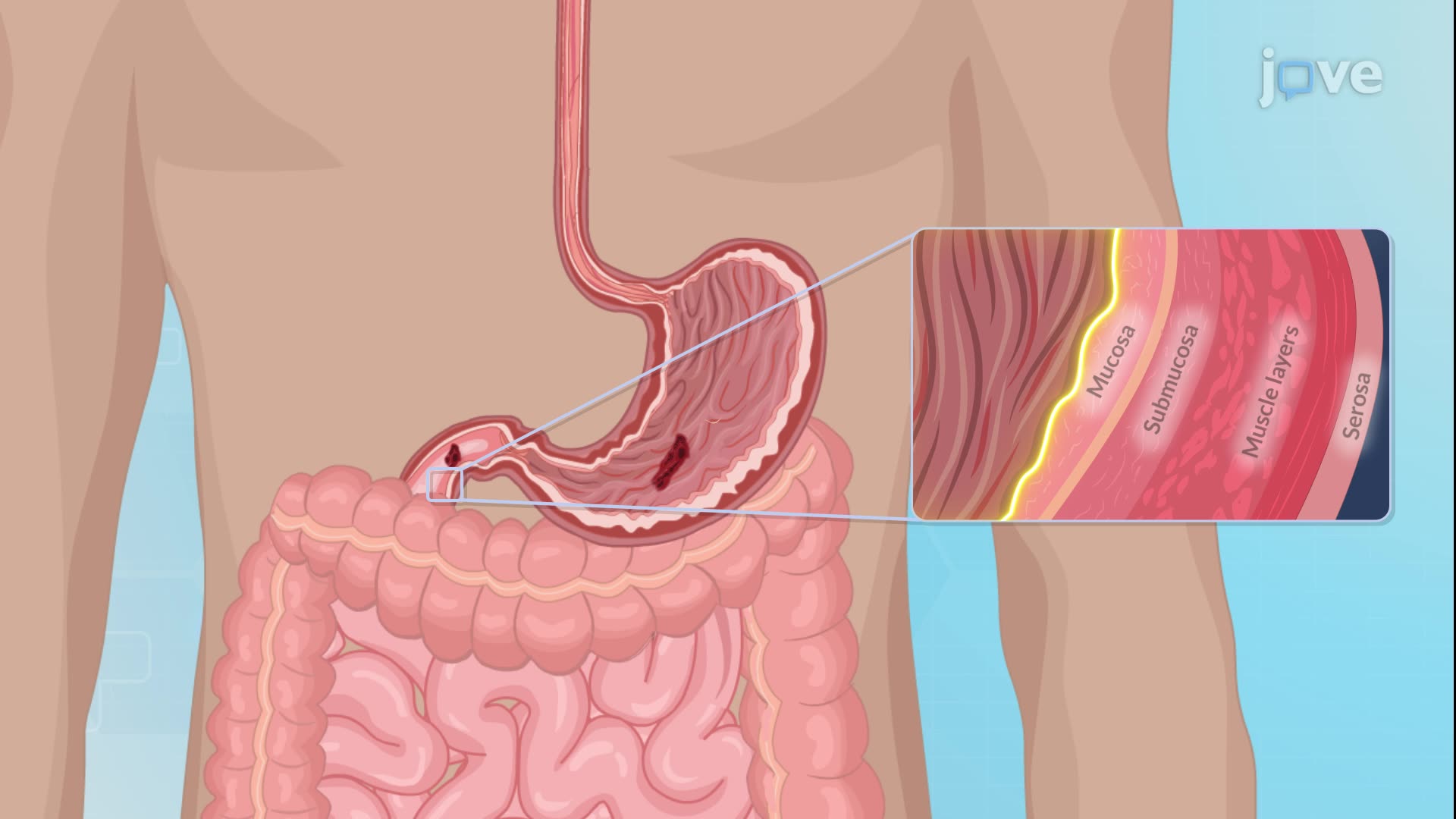 10.5 : Peptic Ulcer Disease II: Pathophysiology
