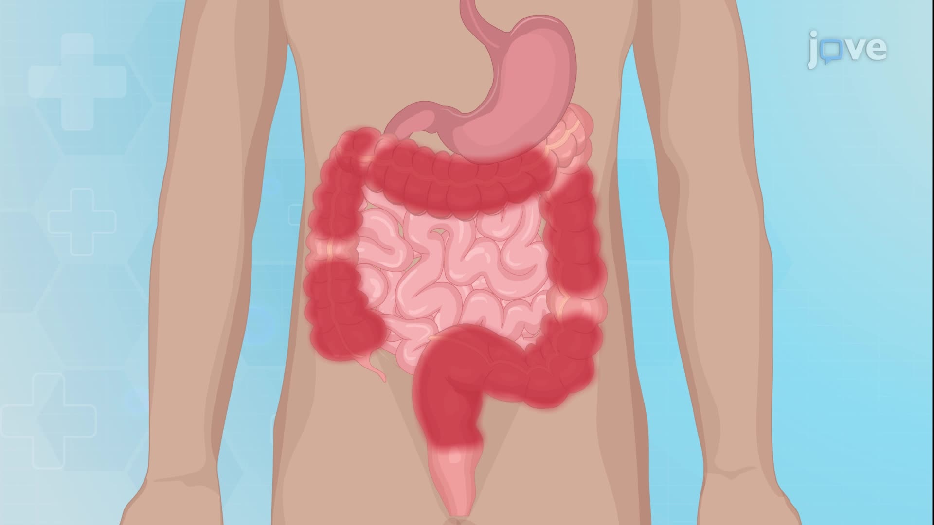 11.14 : Inflammatory Bowel Disease  V: Surgical Management