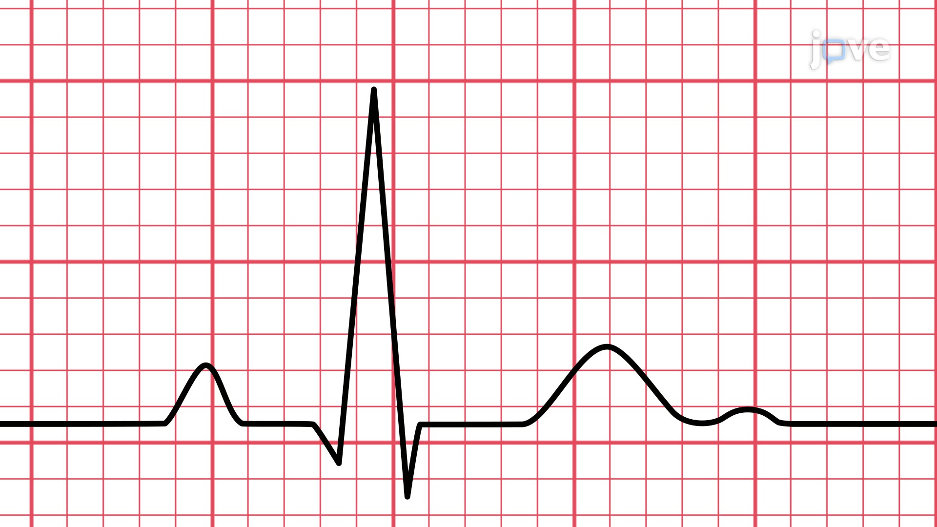 Video ECG Interpretation Of Rhythms
